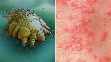  Scabies Mite - The Itch You Can't Scratch Away: Understanding This Tiny Terror That Lurks on Human Skin