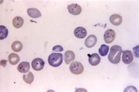  Babesia! A Microscopic Vampire Hiding in Plain Sight!